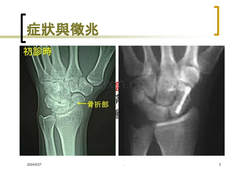 运动伤害与贴扎.ppt_第3页