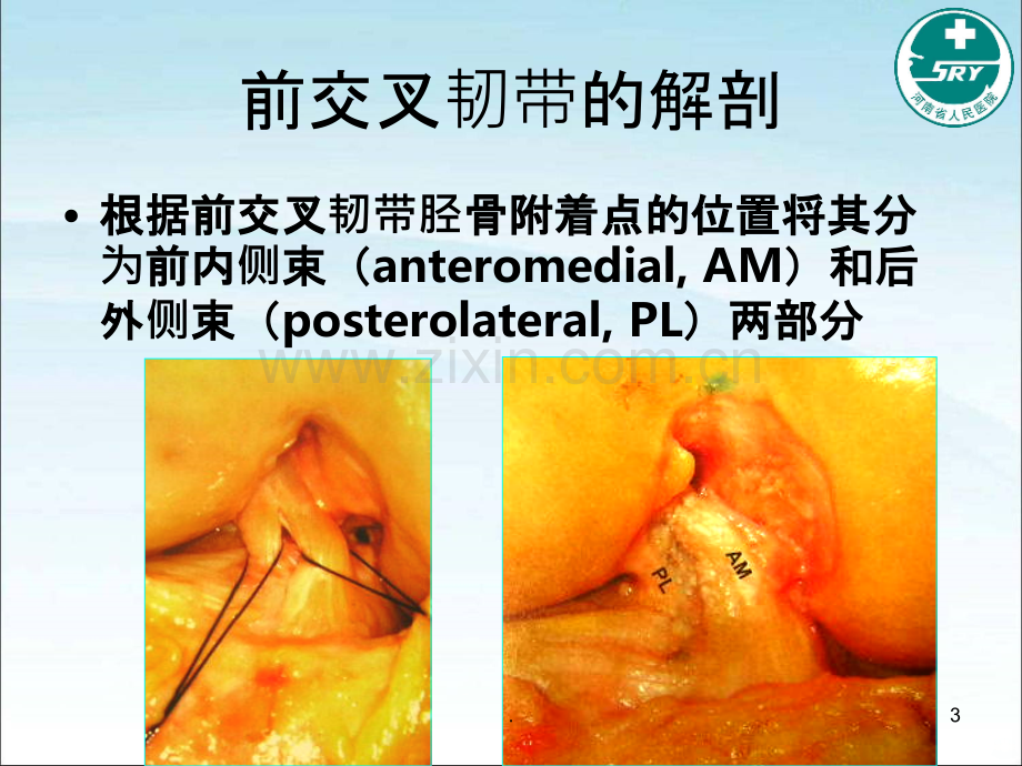 浅谈前交叉韧带损伤.ppt_第3页