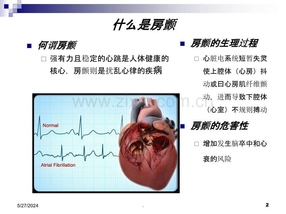 房颤病因检查与治疗.ppt_第2页