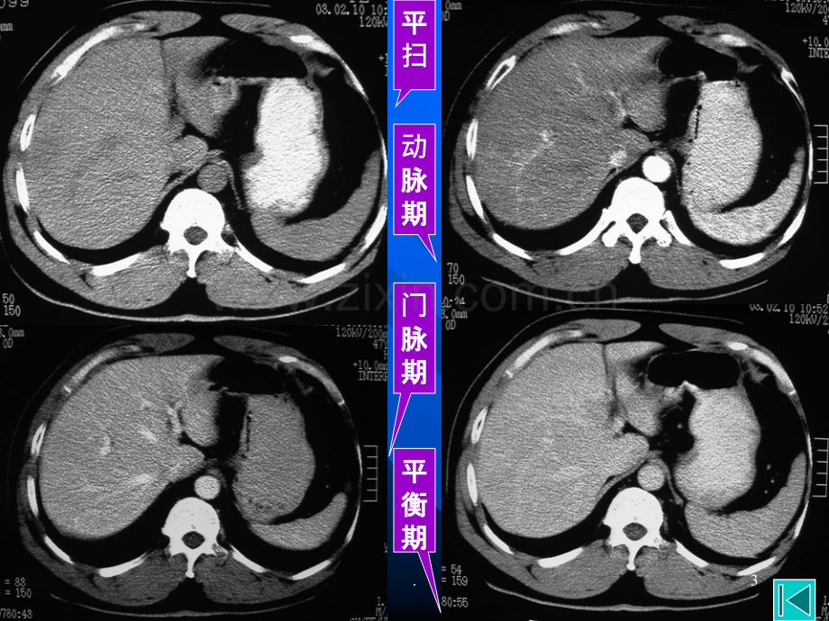 肝脏阅片.ppt_第3页