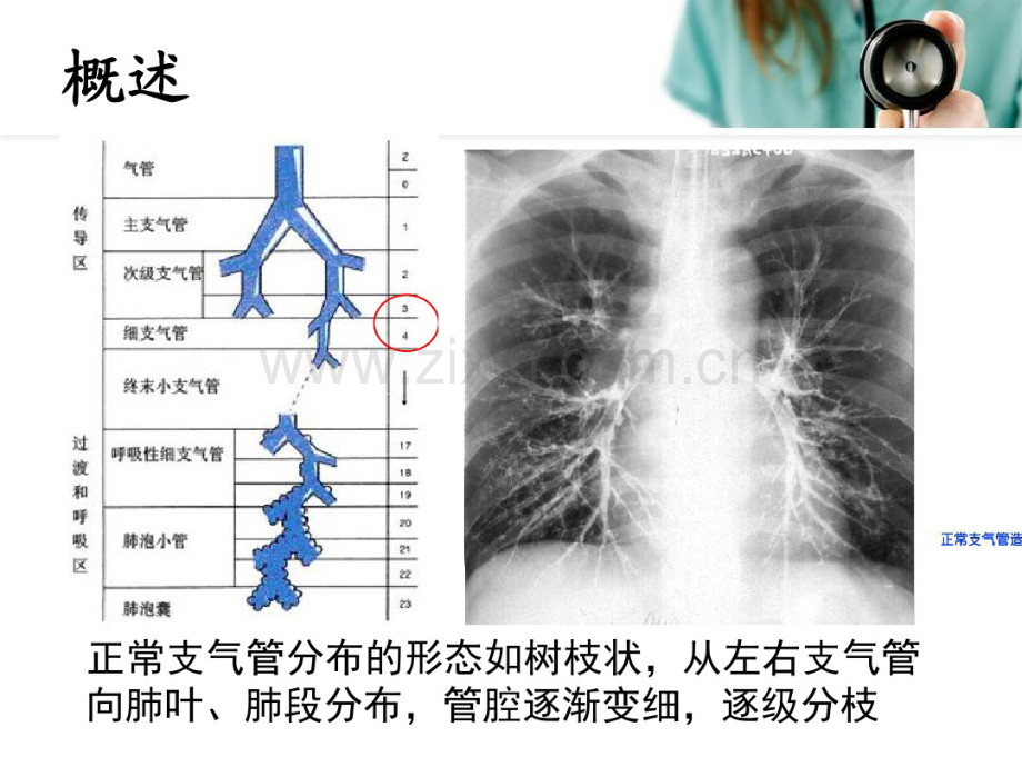 儿童支气管扩张.pdf_第3页