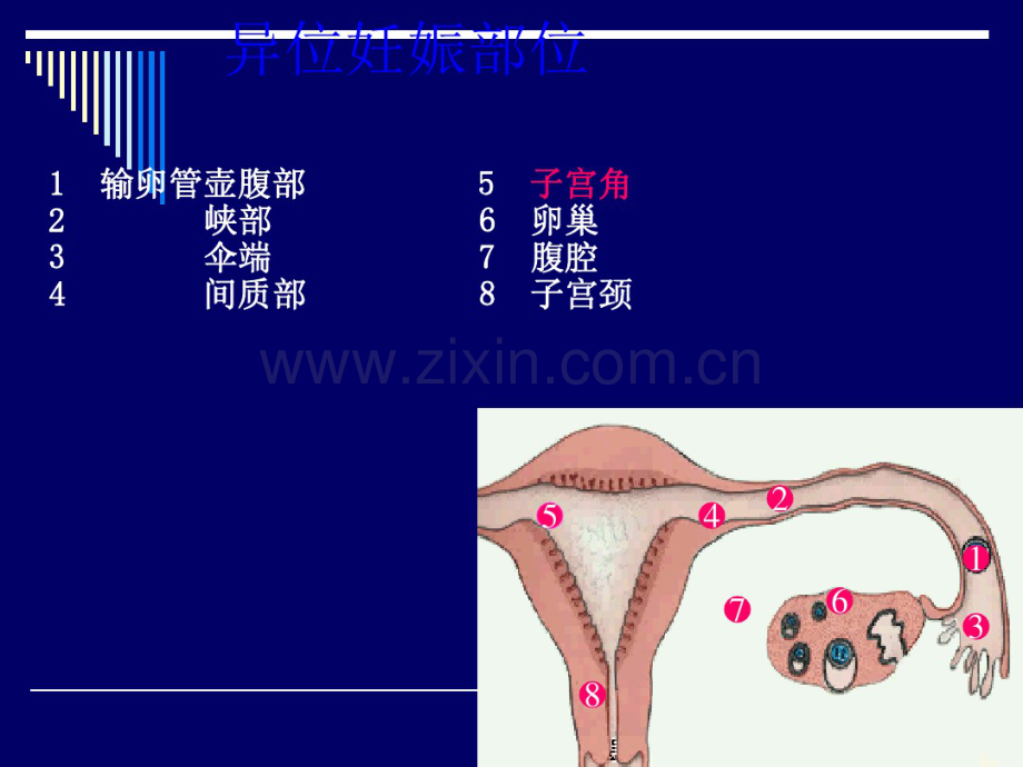 异位妊娠.pdf_第3页