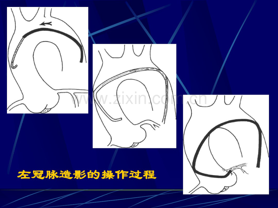 冠脉造影术基础及指引导管选择.pdf_第2页