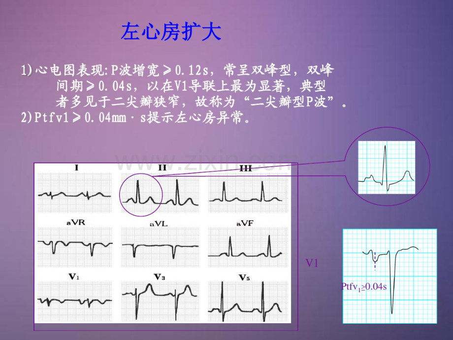 常见异常心电图(20190901095201).pdf_第3页