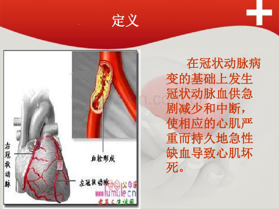 急性前壁心肌梗死护理查房李霞.pdf_第2页