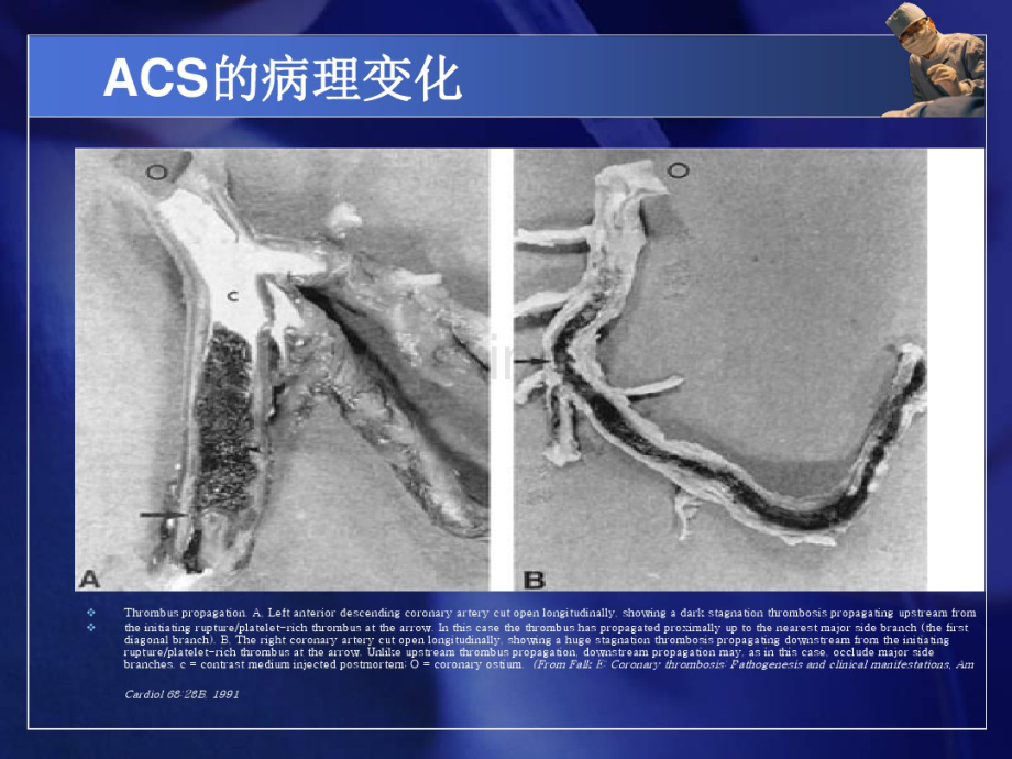 急性冠脉综合征的介入治疗(20190827193114).pdf_第3页