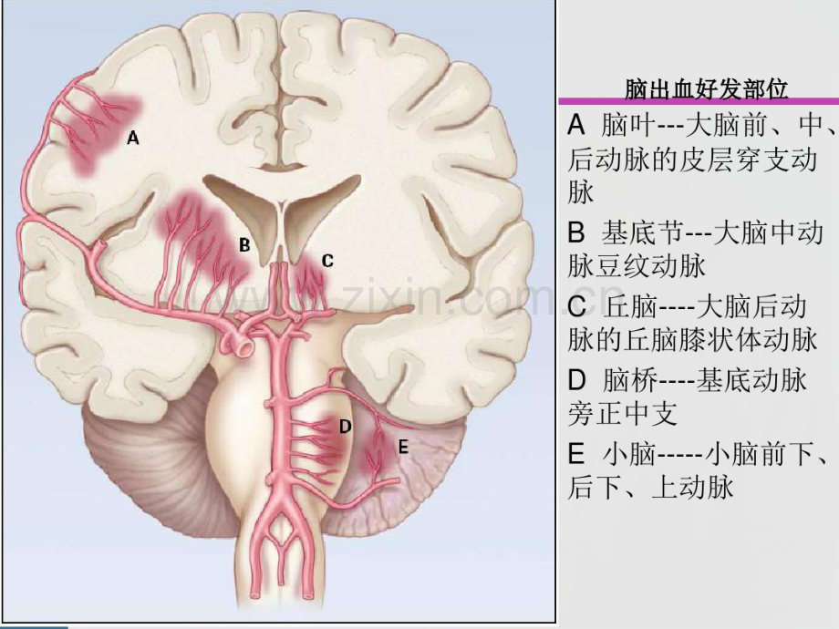 脑出血治疗进展.pdf_第3页