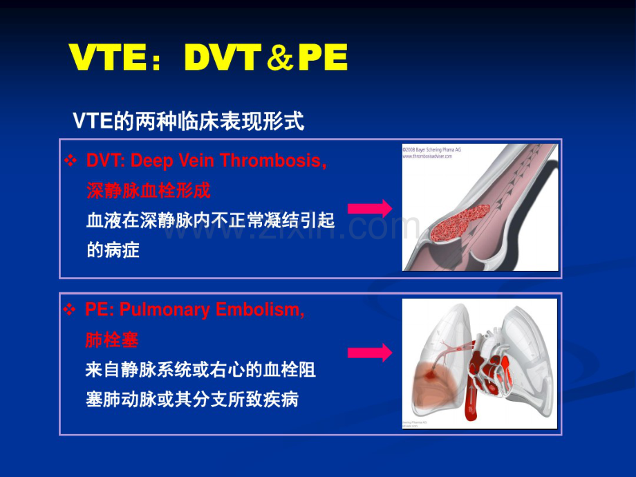 下肢深静脉血栓形成的诊断和治疗.pdf_第2页