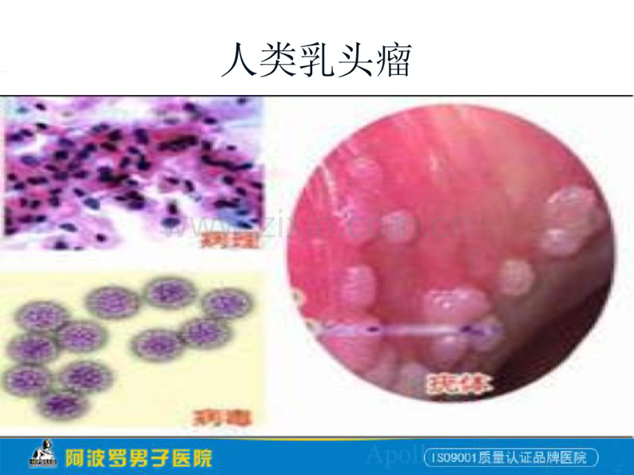 尖锐湿疣.pdf_第3页