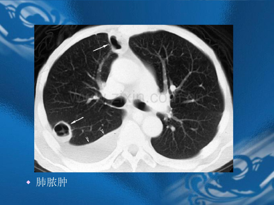 医学影像诊断学-呼吸系统2.pdf_第1页