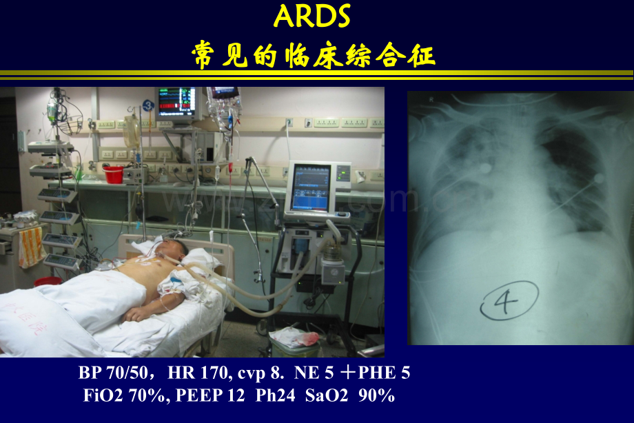 ARDS肺复张的临床实施-医学课件.ppt_第1页