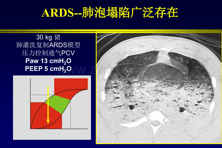 ARDS肺复张的临床实施-医学课件.ppt_第3页