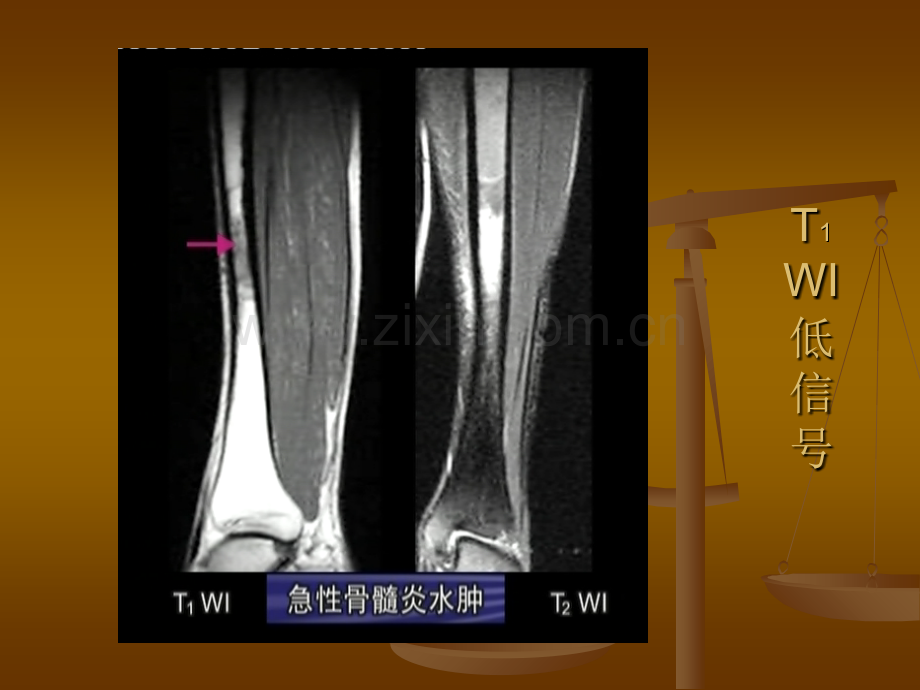 医学MRI读片骨关节病例分析PPT培训课件.ppt_第3页