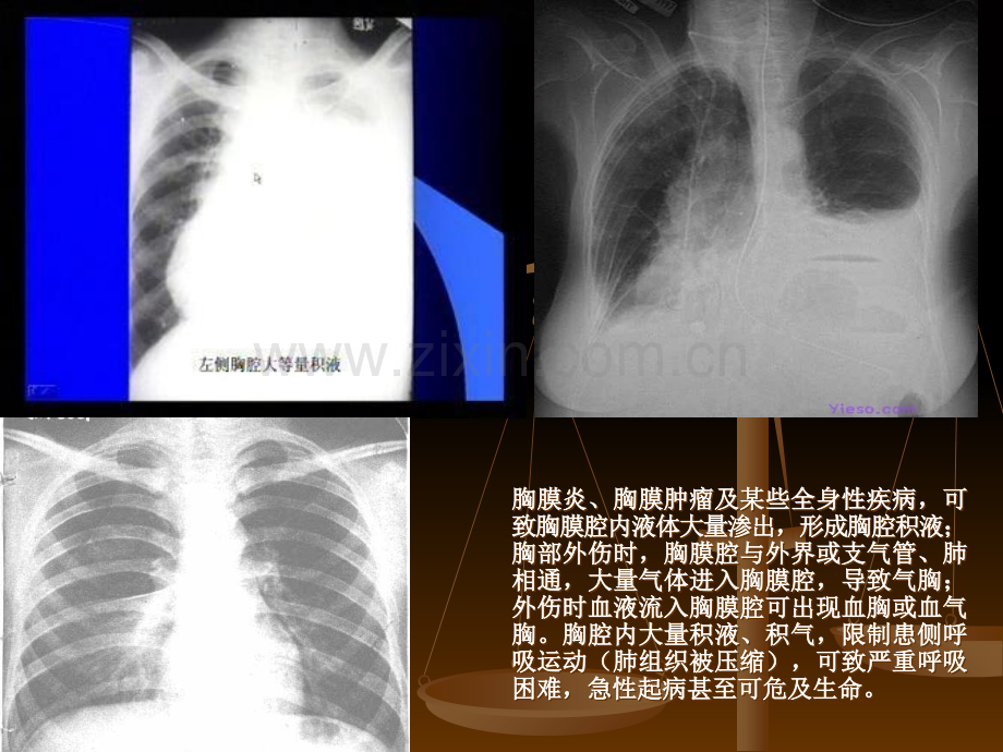 PPT医学课件胸腔穿刺术医学知识专题讲座讲义.ppt_第3页