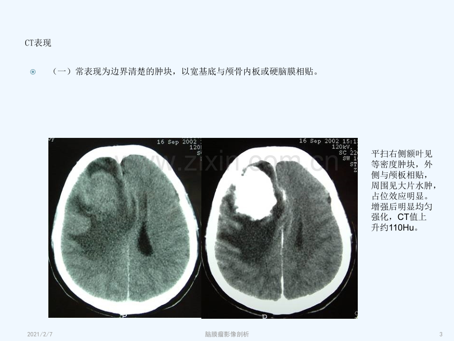 脑膜瘤影像学表现.ppt_第3页