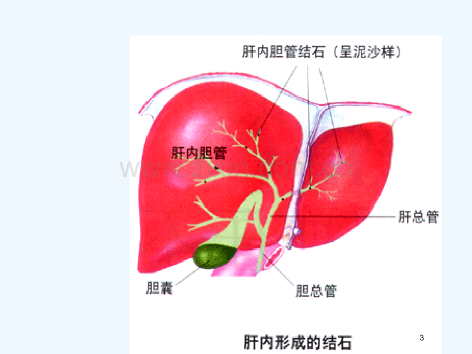 肝内外胆管结石病人的护理.ppt_第3页