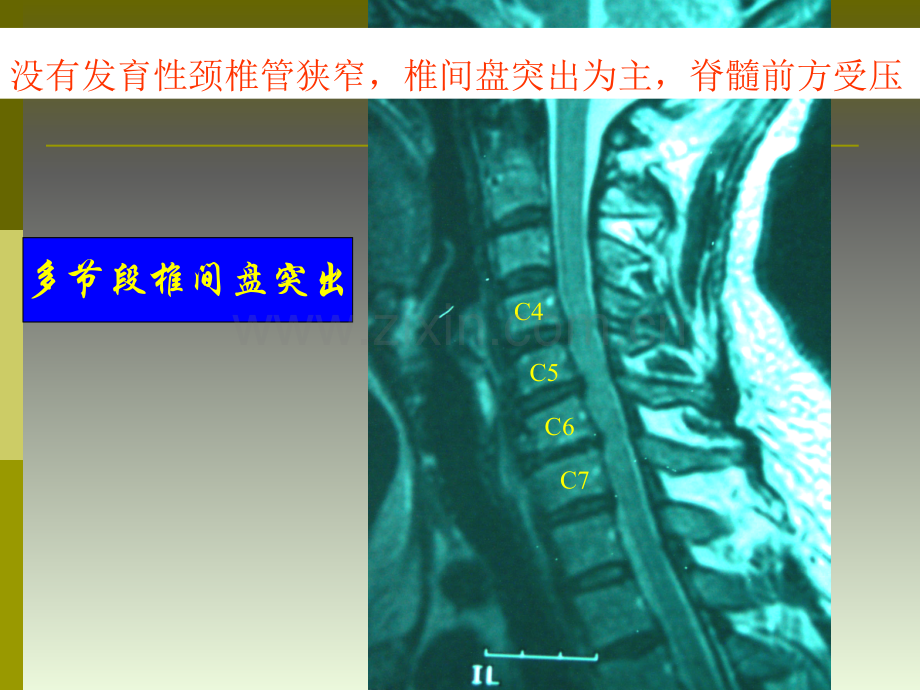 多节段脊髓型颈椎病首选治疗-后路.ppt_第3页