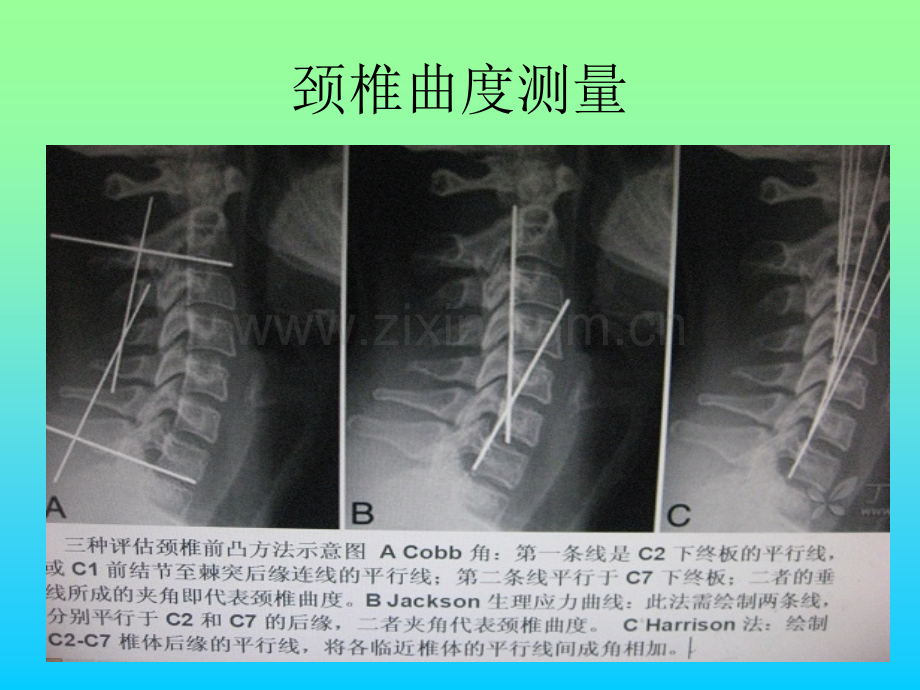 常用脊柱测量方法及其临床意义.ppt_第2页