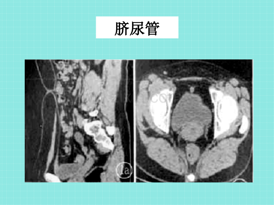 PPT医学课件脐尿管医学知识专题讲座讲义.ppt_第3页