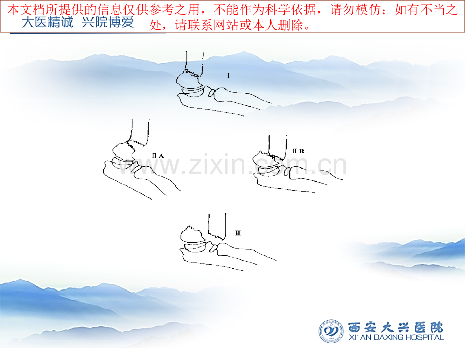 儿童肱骨髁上骨折闭合复位内固定术培训课件.ppt_第3页