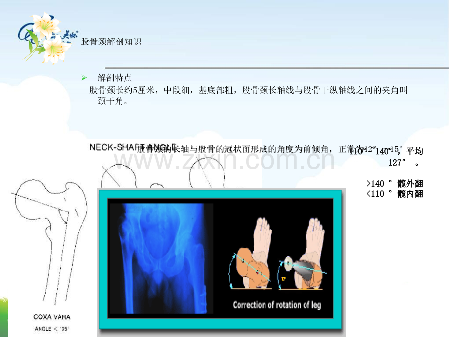 股骨颈骨折的护理郭.ppt_第3页