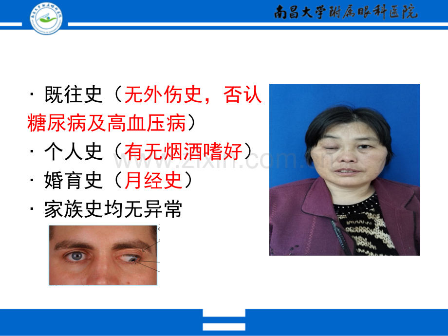 动眼神经麻痹专题宣讲PPT培训课件.ppt_第3页