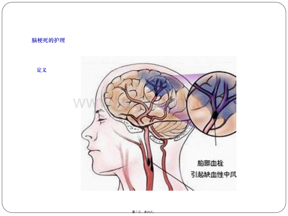 脑梗死护理.ppt_第3页