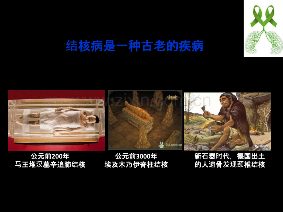 结核分类和诊断标准.ppt_第2页