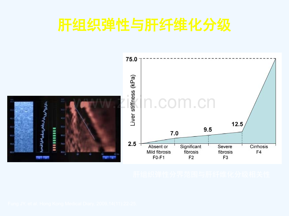 乙肝肝硬化并发症的处理.ppt_第3页