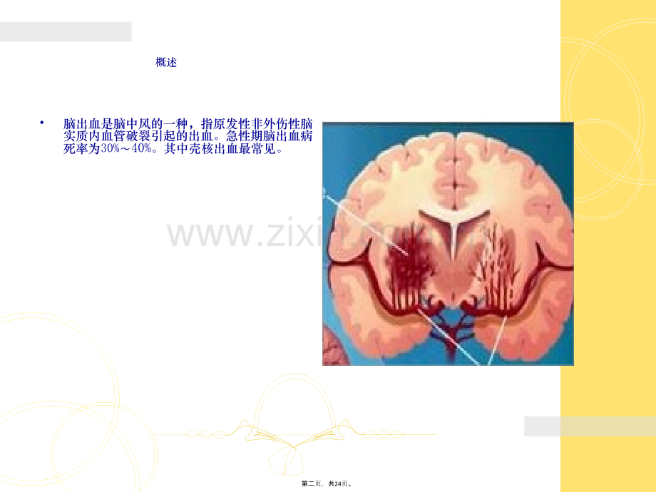 脑出血观察及护理.ppt_第3页