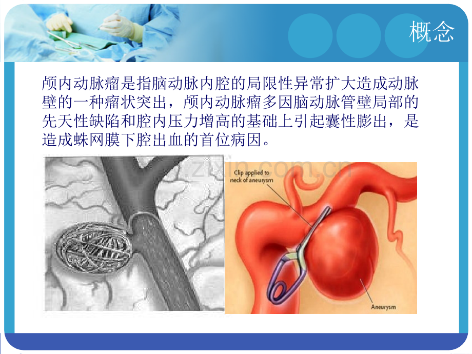 脑动脉瘤夹闭术.ppt_第2页