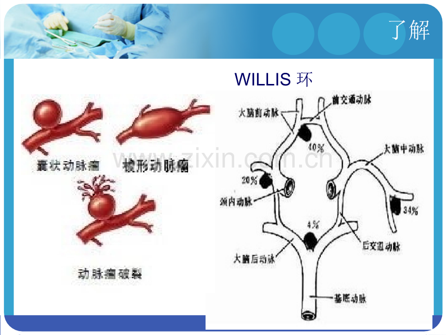 脑动脉瘤夹闭术.ppt_第3页