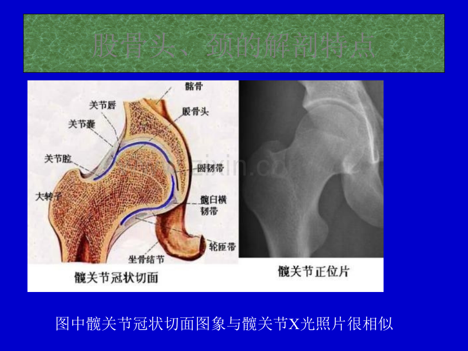 股骨头缺血坏死影像学诊断.ppt_第3页