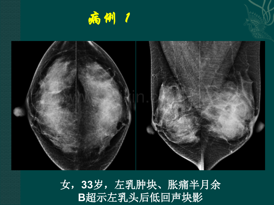 乳腺少见疾病的影像分析汇报ppt培训课件.ppt_第2页