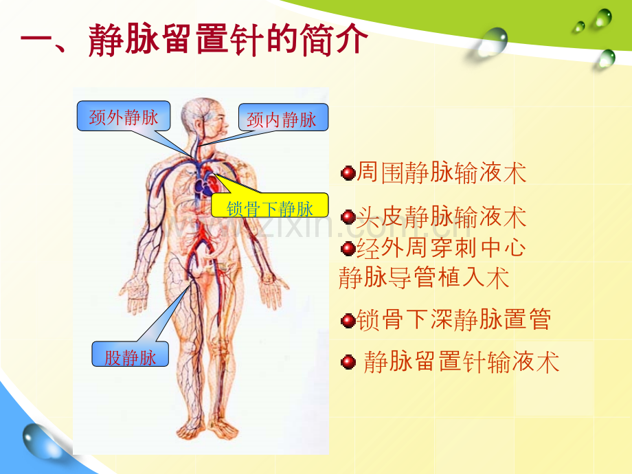 静脉留置针常见并发症预防及护理.ppt_第3页