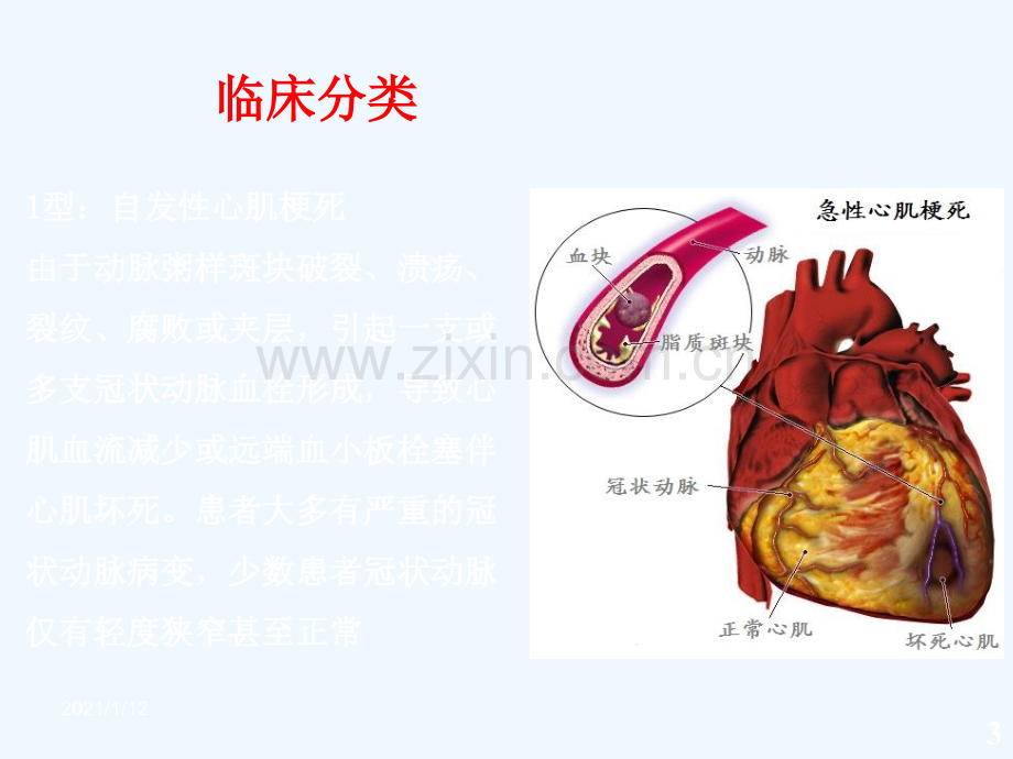 急性心肌梗死与再灌注治疗.ppt_第3页