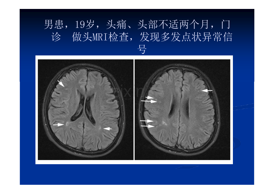 TCD发泡实验在神经内科疾病中应用的典型病例析-医学课件.ppt_第1页