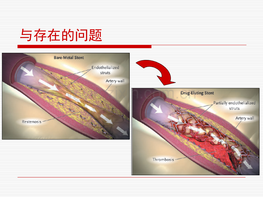 支架内血栓形成的机制与防治.ppt_第3页