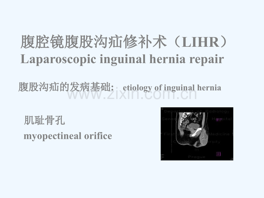 腹腔镜腹股沟疝修补术.ppt_第2页