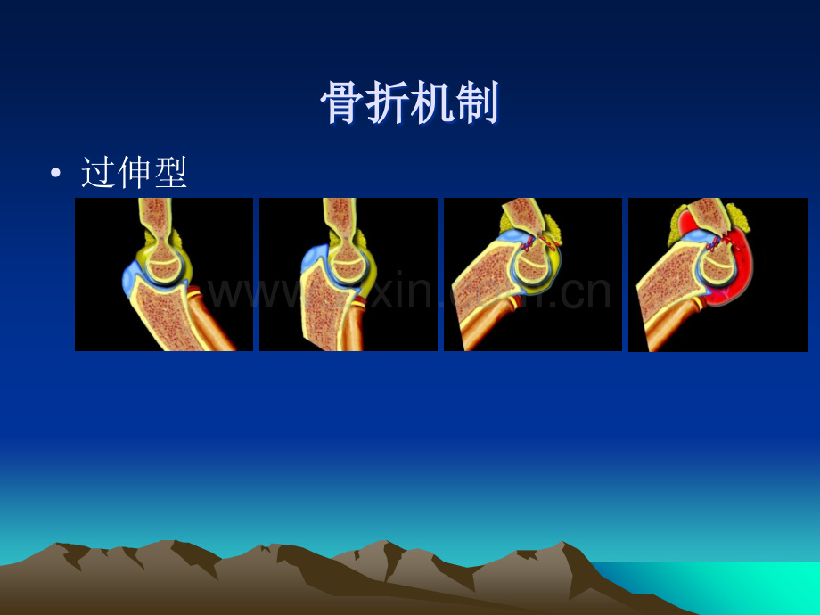 儿童肘关节骨折X线诊断.ppt_第2页