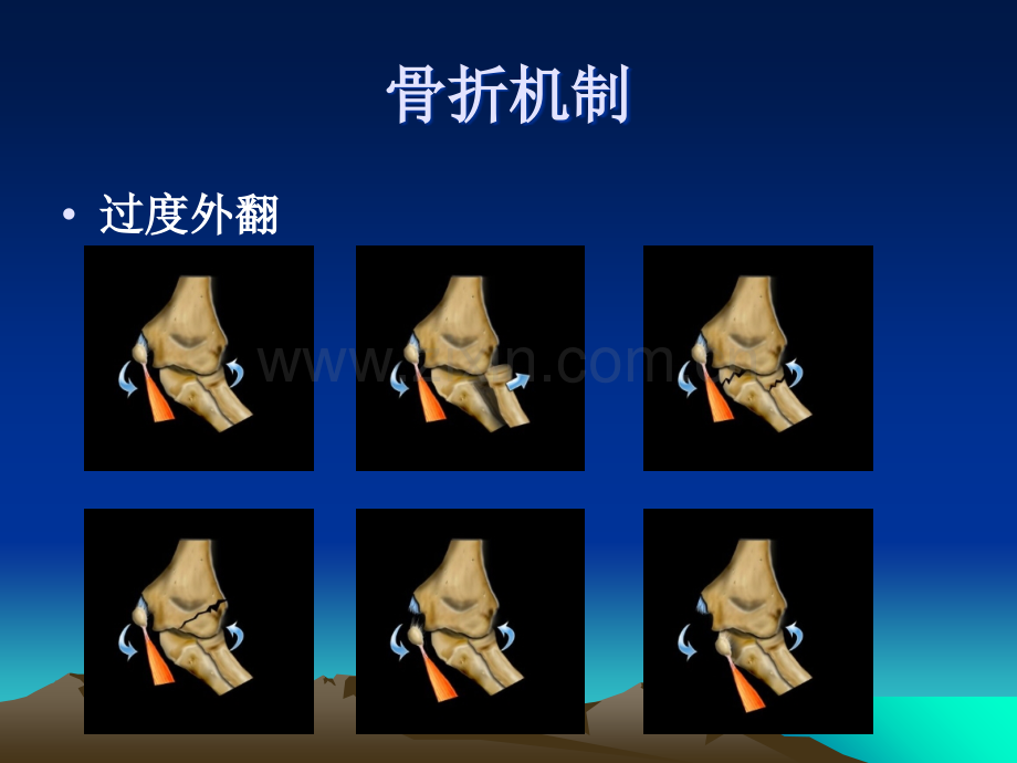 儿童肘关节骨折X线诊断.ppt_第3页