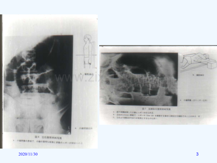 急腹症的线诊断.ppt_第3页