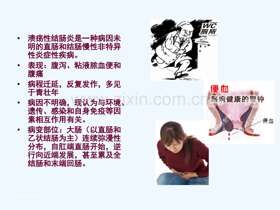 溃疡性结肠炎患者的护理.ppt_第2页