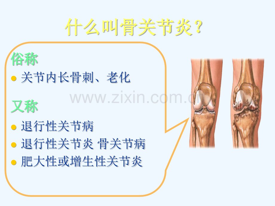 膝关节骨性关节炎的分级治疗63.ppt_第2页