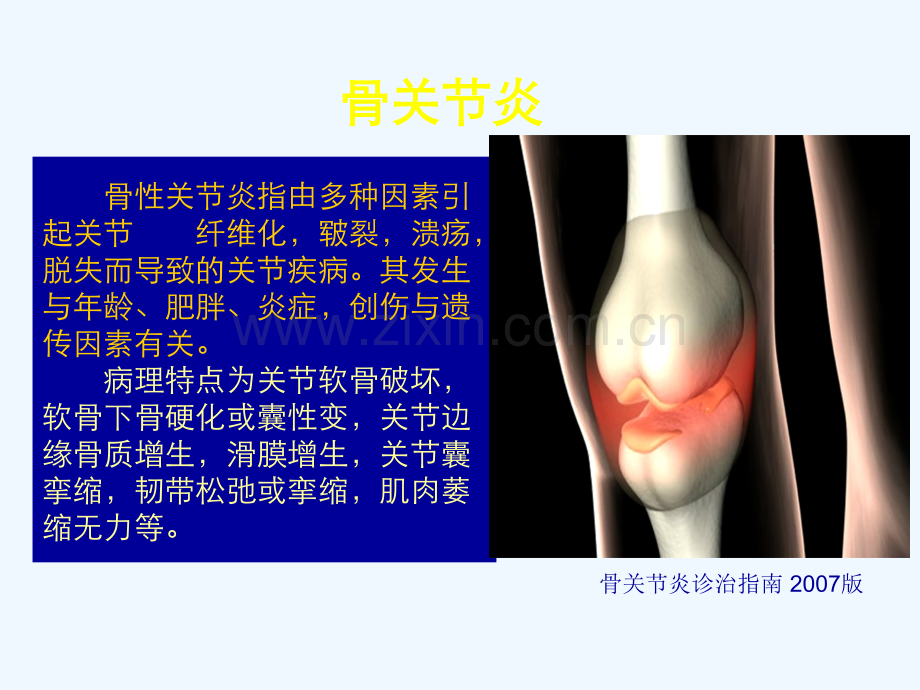 膝关节骨性关节炎的分级治疗63.ppt_第3页