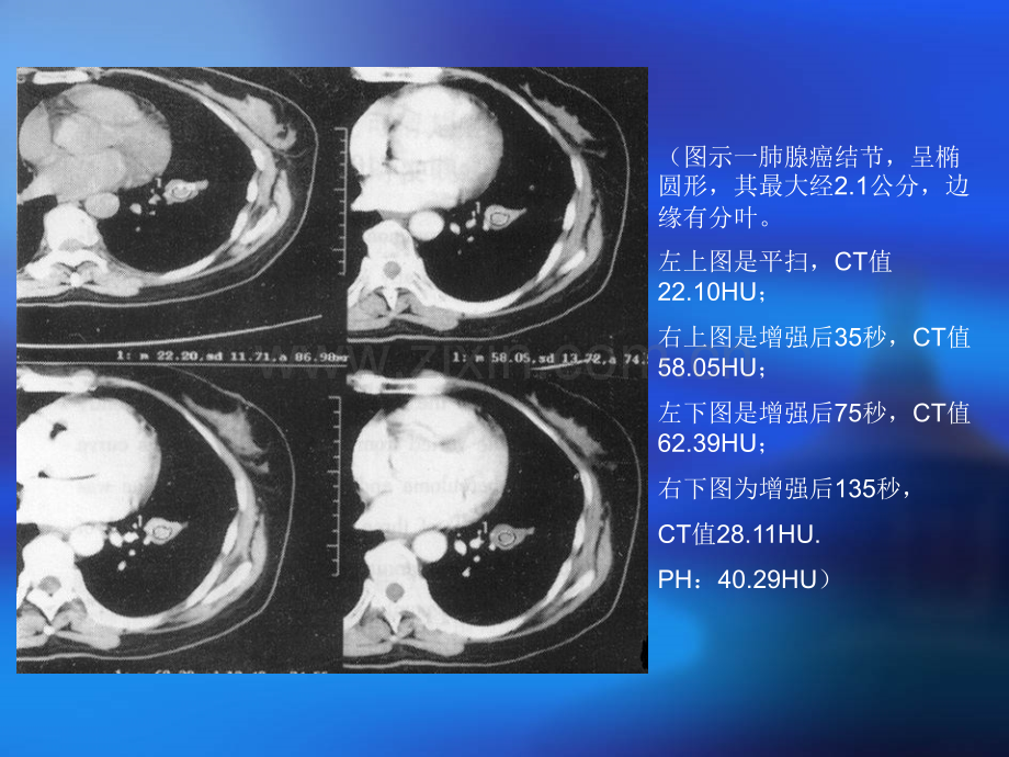 CT增强鉴别肺结节性质-医学课件.ppt_第2页