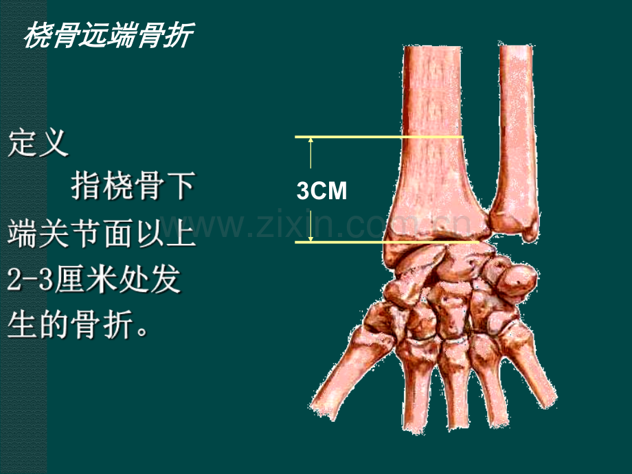 桡骨远端骨折课件.ppt_第2页