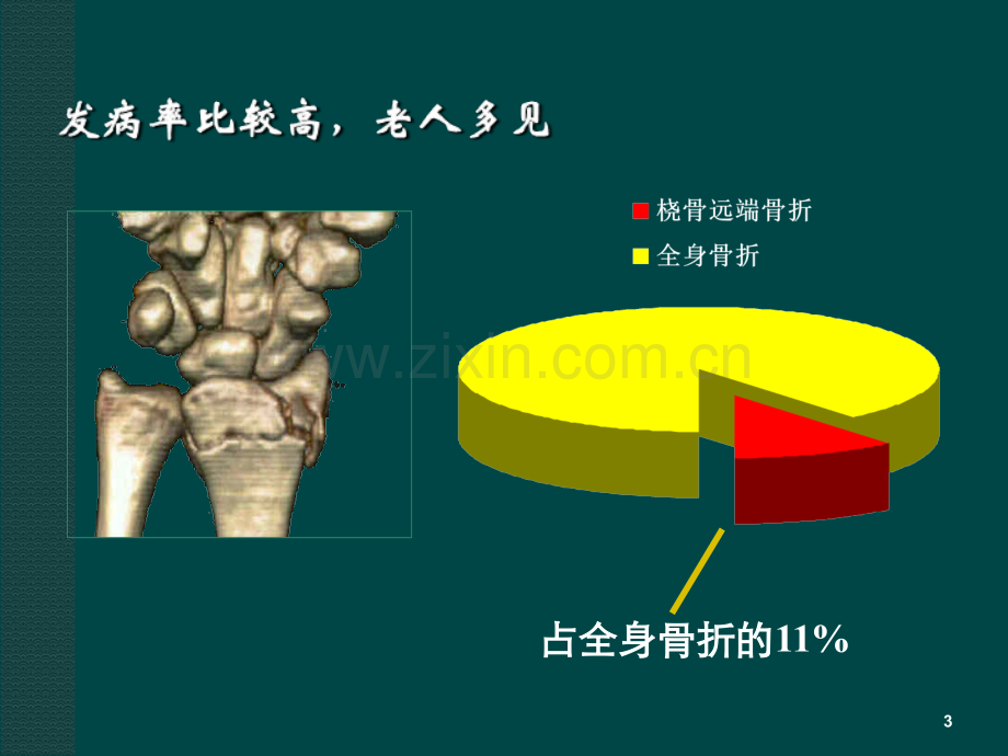 桡骨远端骨折课件.ppt_第3页