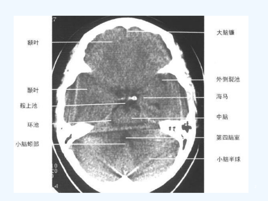 脑出血Cerebralhemorrhage.ppt_第2页