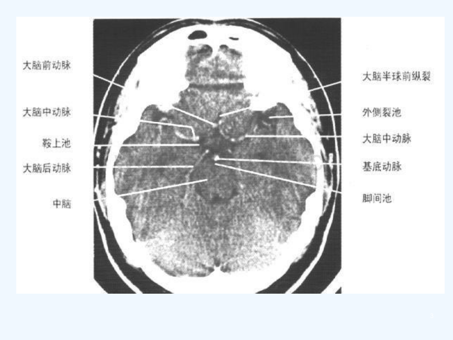 脑出血Cerebralhemorrhage.ppt_第3页